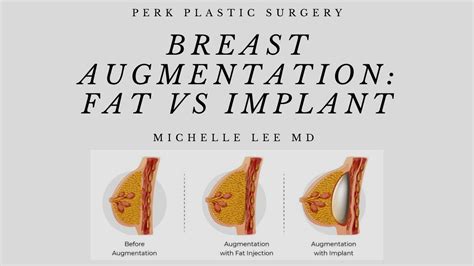 breast augmentation green bay